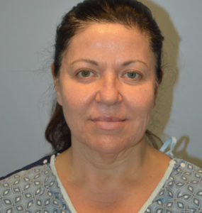Facelift Before and After Pictures Huntsville, AL