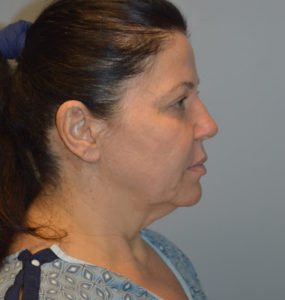 Facelift Before and After Pictures Huntsville, AL