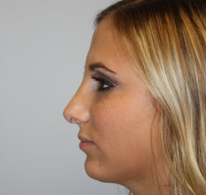 Chin Implant Before and After Pictures Huntsville, AL