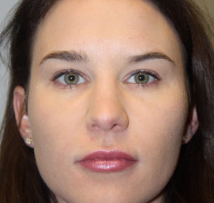 Lip Augmentation Before and After Pictures Huntsville, AL