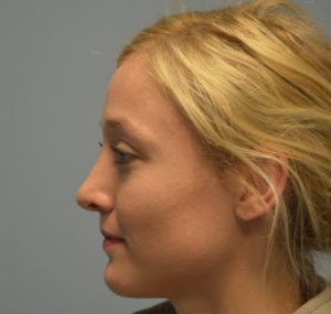 Rhinoplasty Before and After Pictures Huntsville, AL