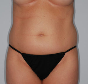 Liposuction Before and After Pictures Huntsville, AL
