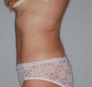Liposuction Before and After Pictures Huntsville, AL