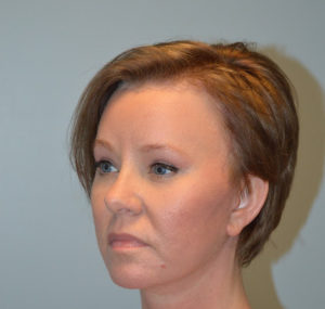 Brow Lift Before and After Pictures Huntsville, AL