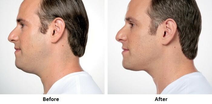 Kybella® in Northern Alabama and the Huntsville Area