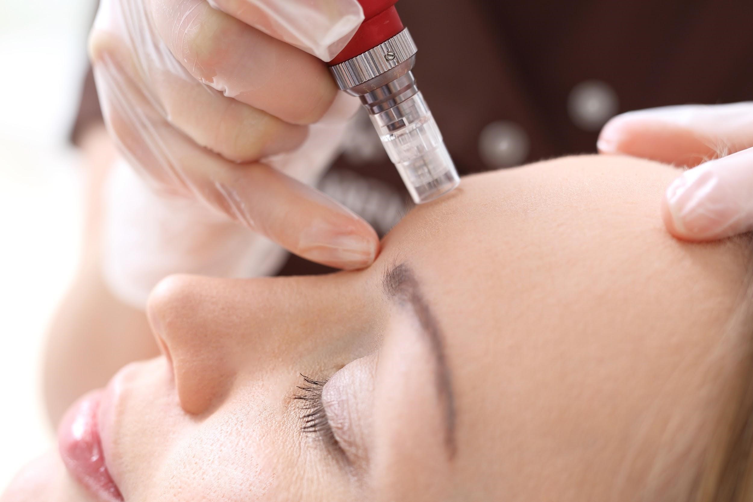 Microneedling in Northern Alabama and the Huntsville Area
