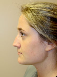 Rhinoplasty Before Pics