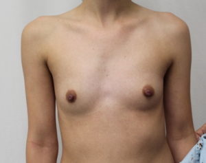 breast augmentation before photos