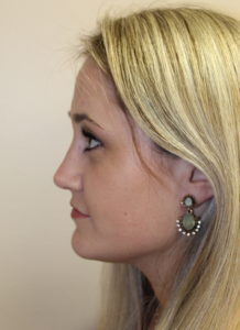 Rhinoplasty After photos