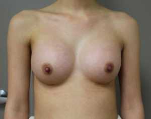Breast Augmentation after photo