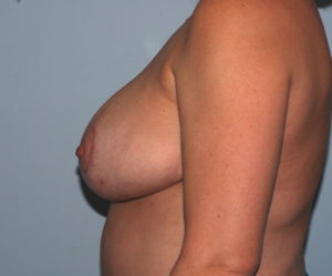 Breast Reduction after photo