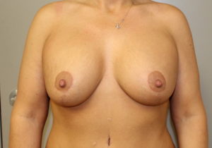 Breast aug with lift