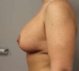 Breast aug with lift