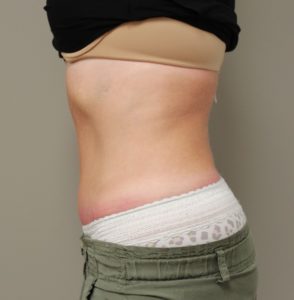 tummy tuck before and after photos
