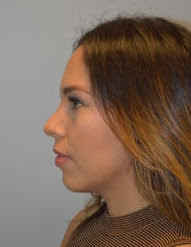 Rhinoplasty and chin implant after photo