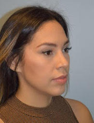 Rhinoplasty and chin implant after photos