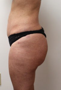 Liposuction and fat transfer before and after photos